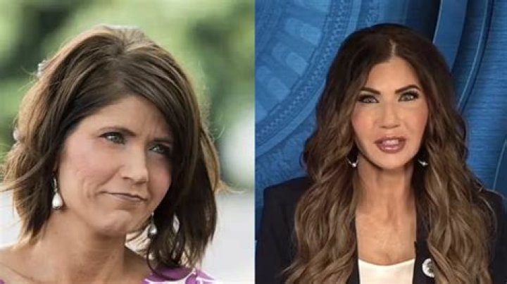 Kristi Noem Plastic Surgery- Before & After Pictures Depicts A Clear Difference