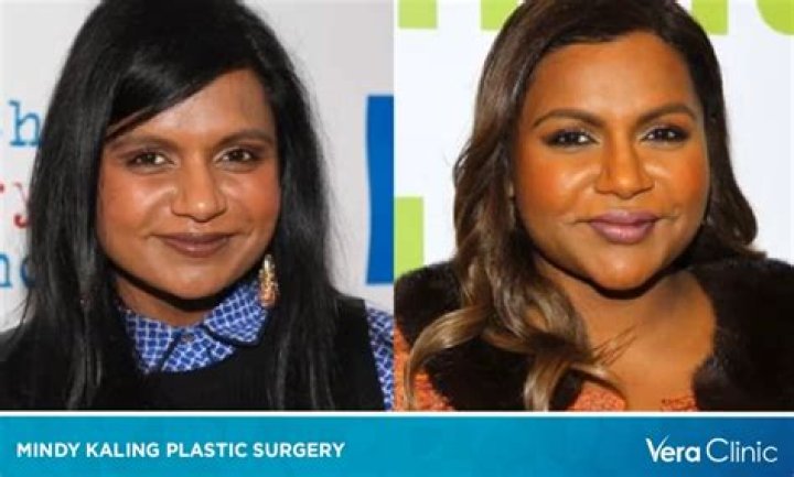 
The Truth About Mindy Kaling Plastic Surgery Rumors 